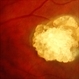 Astrocytic Hamartoma